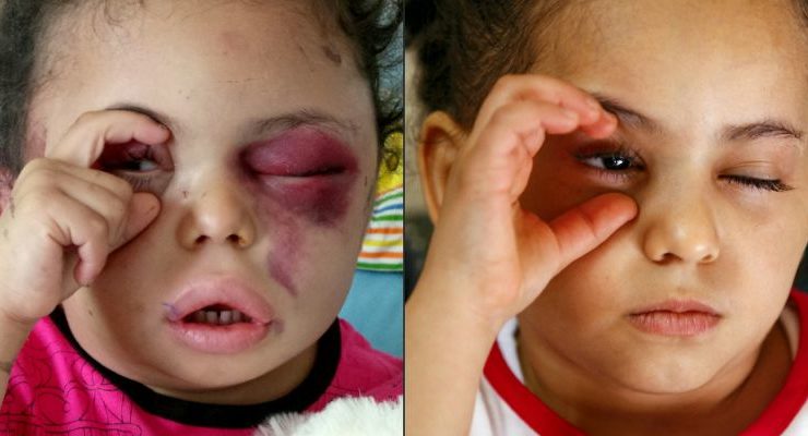 Young Girl’s Tragic Story makes her a Symbol of the Yemen War